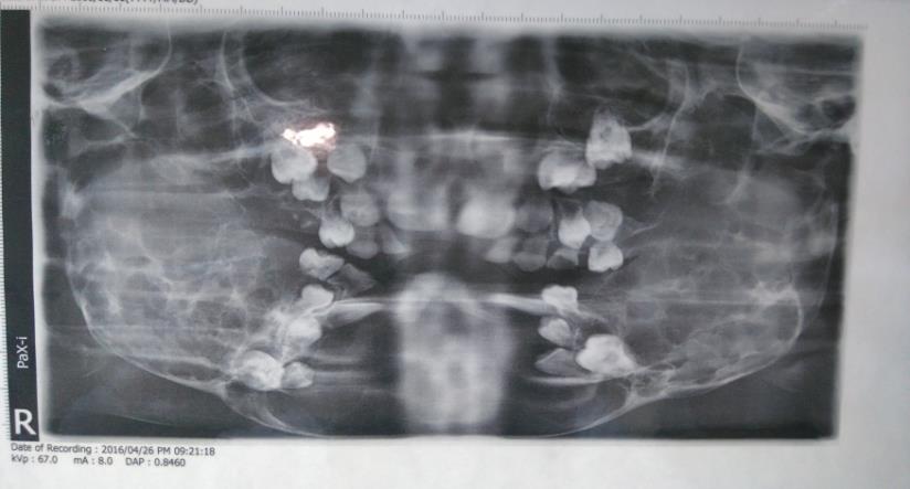 Figure 4: 3D and axial cuts of C.T scan shows bilateral large osteolytic mandibular lesions with condylar sparing & maxillary involvement.