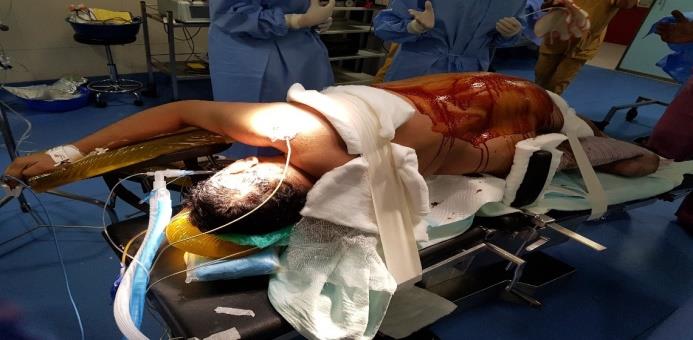 Figure 1: Patient was positioned in the left and right lateral position with raised kidney bridge corresponding to the site of gland operated on.