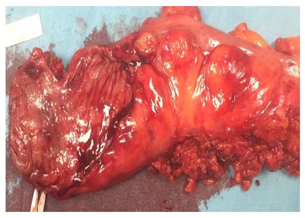 Figure 1: Mid Rectal cancer after chemoradiation in 57 year old male with laparoscopic low anterior resection (TME) in September 2017 (Note the smooth complete mesenteric envelop) Al Zahra Cancer Center, Dubai, UAE.