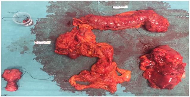 Figure 2: 43 years old lady with colon adenocarcinoma on top of Familial Adenomatous Polyposis had Total colectomy and omentectomy, bilateral salpingooopherectomy with abdominal tumor debulking and peritonectomy followed by HIPEC on October 2017 patient discharged 10 days after surgery Al Zahra Cancer Center, Dubai, UAE.