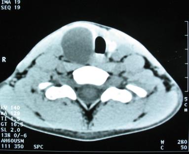 Figure 3: Cervical CT in axial section without injection of contrast: voluminous cystic thyroid mass, without micro- calcifications, or intracystic vegetations or adenopathies, with disappearance of the thyroid parenchyma.