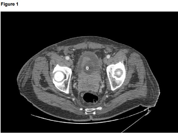 Figure 1: CT contrast scan showing the presence of pathological tissue with contrast enhancement involving the prostate, the bladder trigone and the left seminal vesicle.