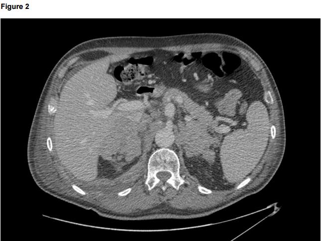 Figure 2: CT contrast scan showing the presence of pathological retroperitoneal tissue compressing the inferior cava vein.