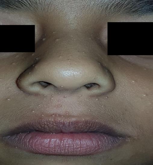 Figure 2: Post curettage of all lesions.