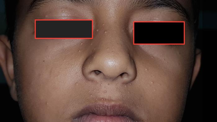Figure 3: Recurrence of multiple facial molluscums after 4weeks.