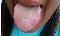 Figure 1: Erythematous lesions with absence of filiform papilla on the body and the lateral border of the tongue due to peanut allergy.
