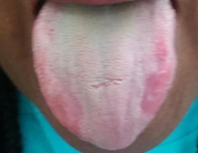 Figure 2: Lesions similar to those of Geographic tongue as a result of peanut allergy.