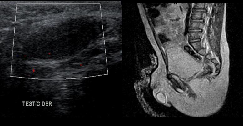 Figure 1: US whit inguinal testicle, IRM with right testicle on scrotal sac.