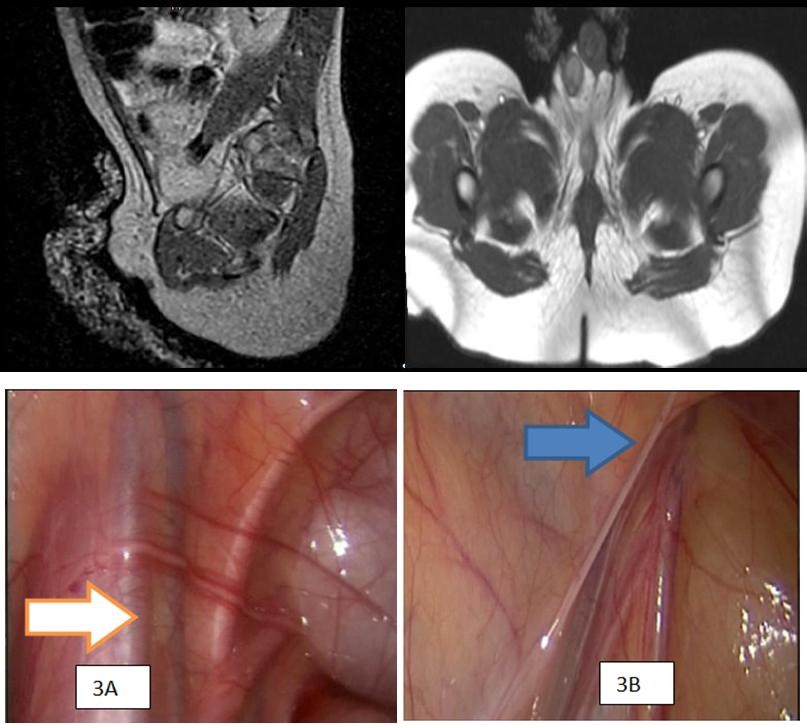 Figure 2: IRM with absence of the left testicle (arrow) 2B) Inguinal region with absence left testicle. It was decided to perform diagnostic and therapeutic laparoscopy no palpable and visible imaging in left testicle. The surgery was performed under general anesthesia in the operating room. The patient was prepared with nasogastric and urinary catheter. The pneumoperitoneum with carbon dioxide is performed using the open technique with Hasson technique, with intraperitoneal introduction of a 5 mm port under direct vision with minimal incision of the umbilical region. Intraabdominal CO2 pressure was 12 mm Hg or less for the trocar placement. Through this umbilical port 5 mm lens attached to a camera and vision is performed on the video monitor it was introduced. Constituted the first step in the exploration of the peritoneal cavity, and then video- laparoscopic under control, two 5-mm ports for instrumentation on each side at the level of the mid- clavicular line were introduced. the anatomical references, such as lateral bladder ligaments, iliac vessels, also the right side he found the path of the vas deferens normally and gonadal vessels of good quality in the inguinal ring (Figure 3A) were found, across the left side, the closed inguinal ring (Figure 3B) vas deferens was found dead-end and absence of gonadal vessels, as well.