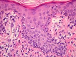 Figure 1: Extra-nodal NK/T cell lymphoma: small atypical lymphoid cells [17].