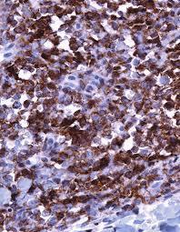 Figure 11: Extra nodal NK/T cell lymphoma- immune reactive for CD56+ [24].