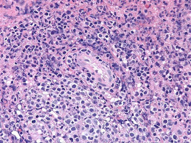 Figure 2: Extra nodal NK/T cell lymphoma: dermal ingress of atypical lymphoid cells [18].
