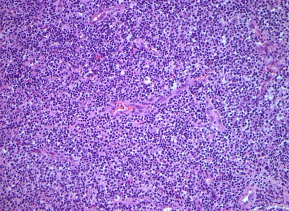 Figure 4: Extra nodal NK/T cell lymphoma: angio- centric articulation of anomalous lymphoid cells [18].
