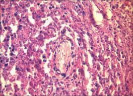 Figure 5: Extra nodal NK/T cell lymphoma – vascular incrimination with coagulative necrosis [19].