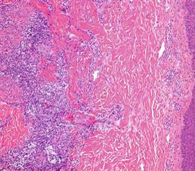 Figure 6: Extra nodal NK/T cell lymphoma large foci of tumour necrosis [19].