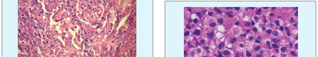 Figure 8: Extra nodal NK/T cell lymphoma: zonal coagulative necrosis with disseminated atypical lymphoid cells [21].