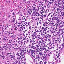 Figure 9: Extra nodal NK/T cell lymphoma: clear cytoplasm, vesicular nuclei [22].