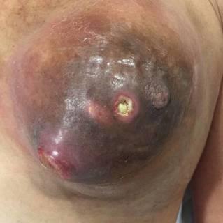Figure 1: Ulcerated mass in left breast.