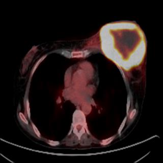 Figure 3: PET-TAC: mass in the left breast with peripheral glucose uptake, high suspicion of malignancy.