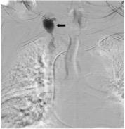 Figure 1: Venous angiography: Venous pseudoaneurysm secondary to a precise lesion located in the jugulo-subclavian confluence probably related to multiple puncture attempts to obtain central venous access from previous catheters.