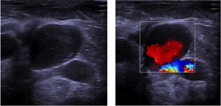 Figure 2: Ultrasound image with finding of jugular vein aneurysm with evidence of internal flow with color Doppler signal.