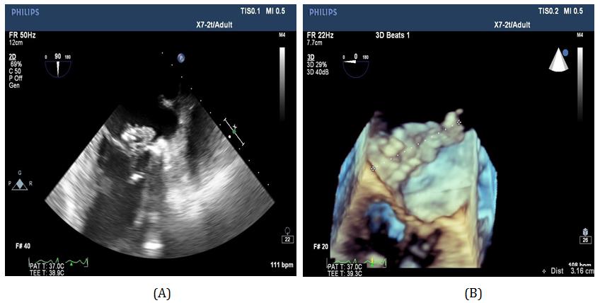 Figure 2: A) 2D TEE showing large vegetation on the mitral valve.