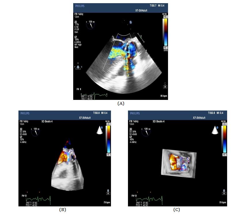 Figure 9: A) 2D TEE showing aortic root abscess with severe paravalvular regurgitation.