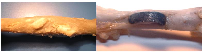 Figure 5: Application of bioceramics in the defects of different bones. Using of biocomposites in oral and maxillo-facial surgery is possible (Figure 6):