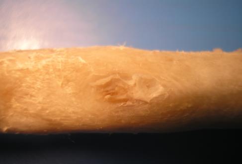 Figure 7: In oral surgery - treatment defect of alveolar process with bioceramics to successive implantation