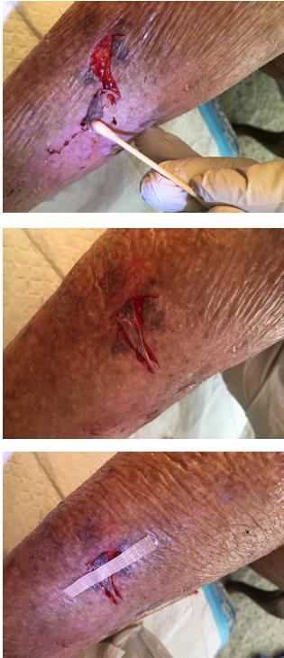Figure 3: The flap should be repositioned as a split thickness skin graft held in place by a steri-strip. Not more than one steri-strip should be used as a purulent discharge may accumulate under more. This is a sign of scurvy and not a condition in itself. Oral vitamin C is mandatory. Further dressings with adhesive surfaces may cause further tearing of the epidermis.