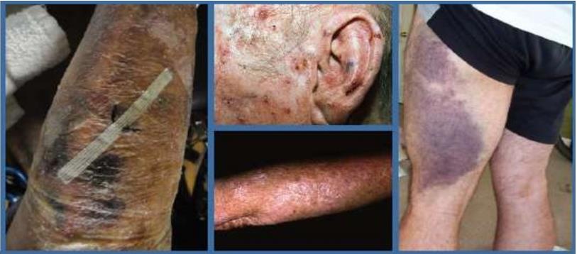 Figure 7: A- Purpura with skin tear. B- Actinic keratosis of the face and forearm due to excessive sun exposure. C- Capillary trauma with dermal bleeding.