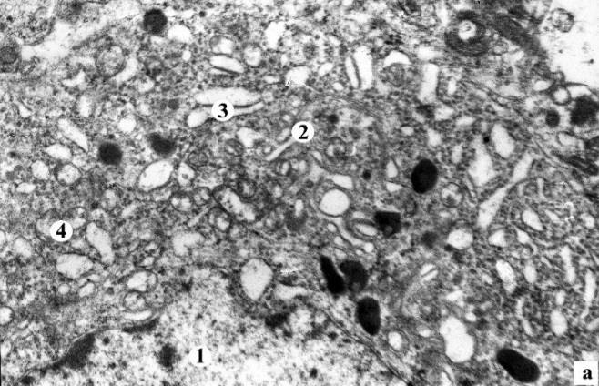 Figure 7: Ganglionic cell of III (а) and IV (б) groups of animals Electromicroscopy. Magn.: а) x4800, б)x6400 Notes: 1 – neuron’snuclei, 2 – new mitochondria, 3 – vacuole, 4 – endoplasmaticnet, 5 – neuron with vacuole dystrophy indirect sign of more intensive activation of neurosecretory processes under the action of combined treatment using PES, in comparison with monotherapy with corticosteroids.