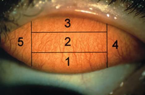Figure 1: Five zones of the upper palpebral conjunctiva of the right eye.