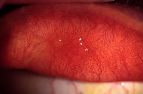 Figure 2: An example of a case of local CLPC at 16x mag.