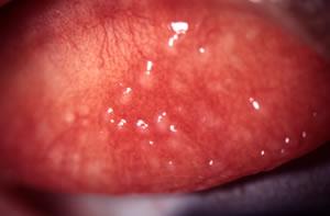 Figure 3: An example of a case of general CLPC at 16x mag. Note enlarged Note enlarged papillae in zone 2 of the upper palpebral conjunctiva papillae in zones 1,2 & 3 of the upper palpebral conjunctiva.