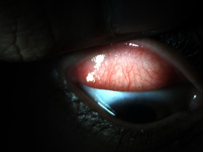 Figure 4: Right Eye. Figure 5: Left eye.