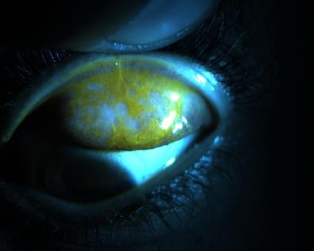 Figure 6: Fluorescein staining under cobalt blue light.