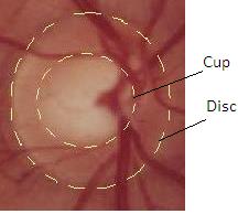 Figure 1: Optic cup plays an important role in glaucoma detection [3], the enlargement of which with respect to OD is an indicator of glaucoma.