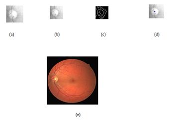 Figure 4: OD localization: (a) Cropped image around approximate OD center obtained after pre-processing, (b) resized cropped image, (c) Edges obtained with canny threshold, (d) OD center after Circular hough transform (CHT), and (e) Result of CHT shown on original (uncropped) image.