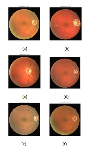 Figure 6: We validate the presented methodology using ground truth that was manually set by the experts on the images. In order to analyze the performance of algorithm the ratio R and sensitivity are calculated.