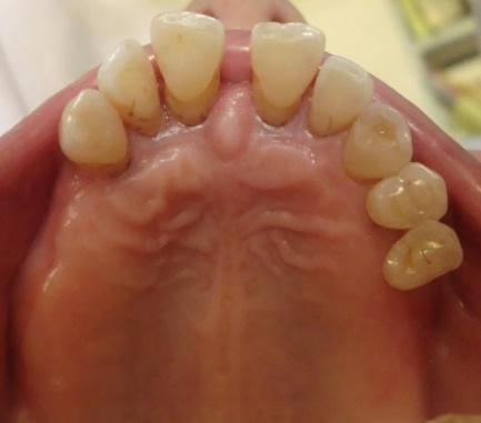 Figure 1: Maxillary arch.