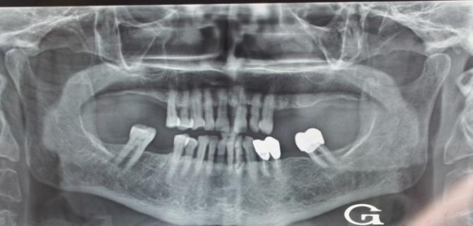 Figure 4: Panoramic radiograph.