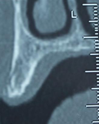Figure 5: Oblique slide at the level of left premolar maxillary sector. Our prosthetic decisions were: - Two metal-ceramic crowns supported by two dental mini implants with a diameter (Ø) of 2.5 mm and a length (L) of 13 mm. in position of 24 and 25. - Two metal-ceramic crowns supported by two implants with a diameter of 3,75mm and a length of 11,5 mmin position of 26 et 27 - A metal-ceramic implant-supported crown in position of 16 (Ø 3,75mm /L.8 mm). - Two mandibular metal-ceramic bridges.