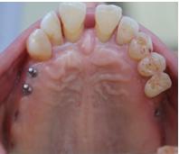 Figure 6: Occlusal view of the maxillary arch after implants placement.