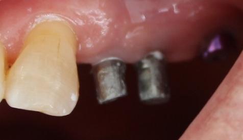Figure 7: View of sealed abutments on mini dental implants.
