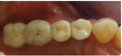 Figure 9: Occlusal view of the right maxillary rehabilitation.
