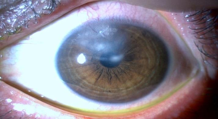 Figure 1: Tuberculosis Interstitial Keratitis.