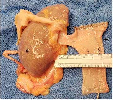 Figure 3: RRV reconstruction in a T configuration using vascular stapler and hand suturing of the ostium of the left renal vein (arrow) to preserve the full length of the IVC.