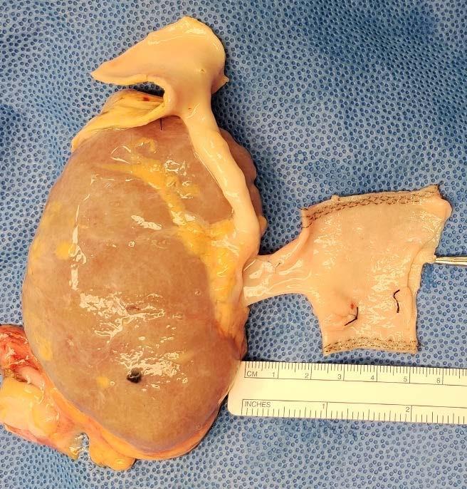 Figure 4: Reconstruction with IVC patch and vascular stapler, using ostium of LRV for outflow. Gonadal vein is tied.