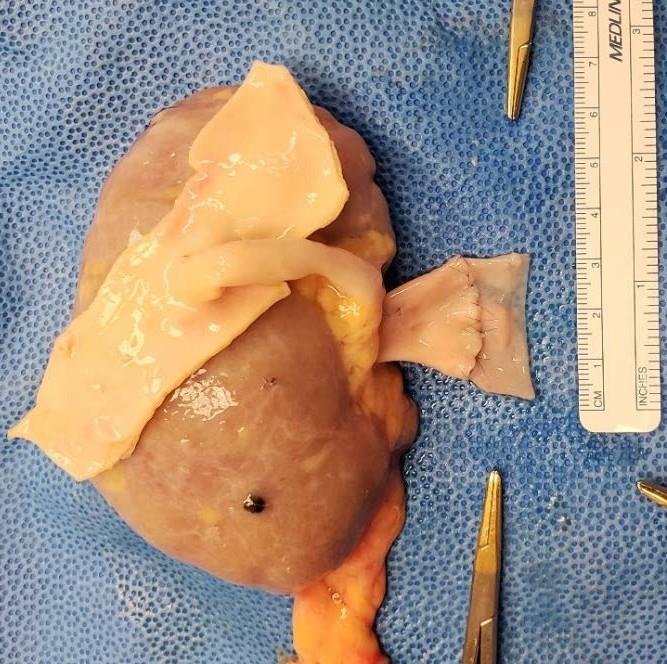 Figure 6: Autologous vein extension in place.